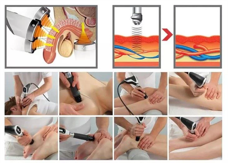 Ed Shockwave Therapy Machine