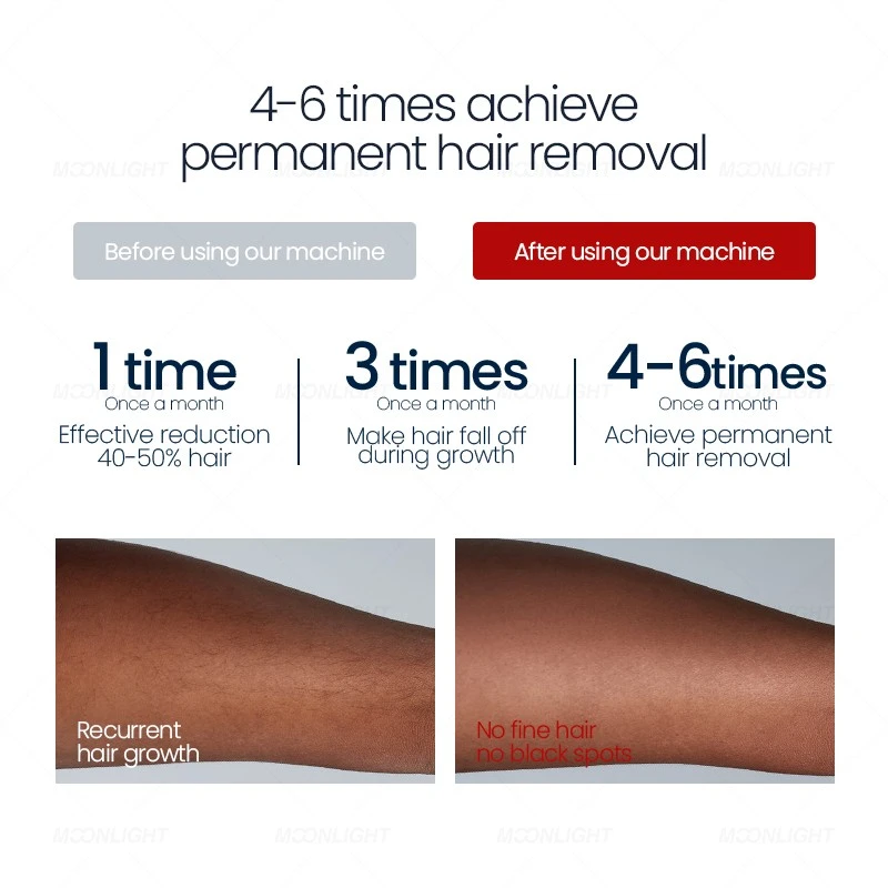 Medical-Grade Diode Laser Hair Removal System high quality